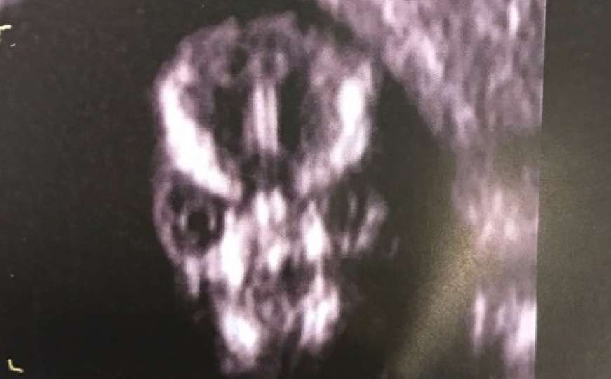 Trudnica ostala u šoku nakon što je na ultrazvuku vidjela bebinu glavu 