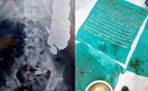 Muškarcu iz stomaka izvadili 263 novčića i 100 eksera