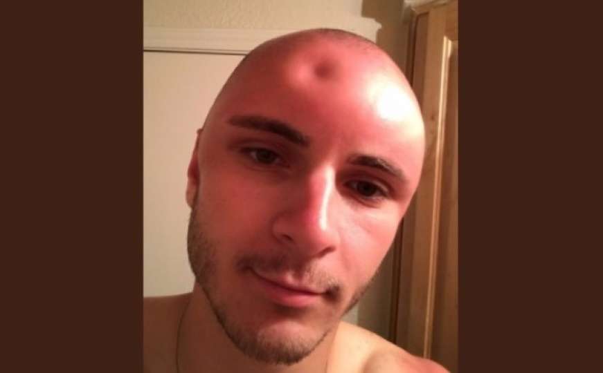 Jezive fotografije: Zbog opekotina od sunčanja, na glavi mu nastala rupa