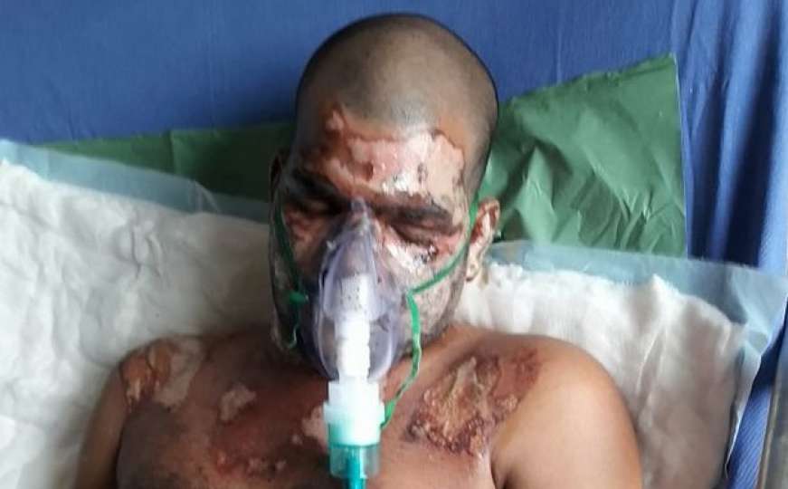 Ljubavniku spalila lice da bi uzeo identitet muža kojeg je ubila