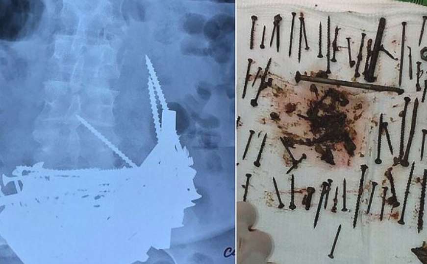Ljekari iznenađeni: U stomaku pacijentkinje pronašli eksere, šarafe i armaturu