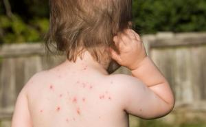 Drugi smrtni slučaj u regiji: Preminuo dvogodišnjak od posljedica malih boginja