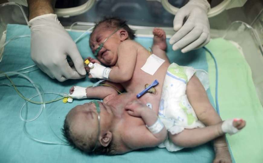 Uspješno razdvojene sijamske blizanke iz Gaze