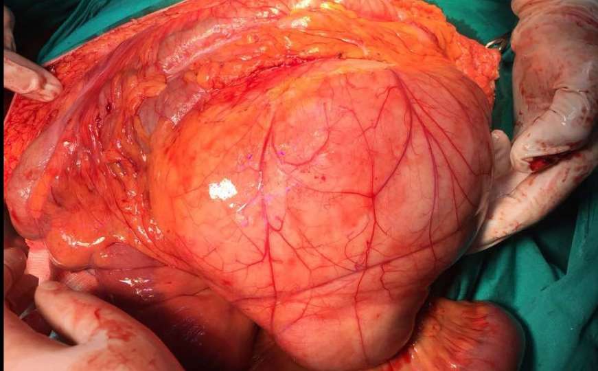 Pacijentici na KCUS-u odstranjen tumor od 11,4 kg