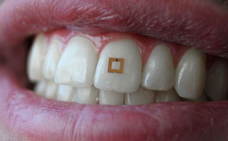 Minijaturni senzor na zubu moći će bilježiti unos hrane