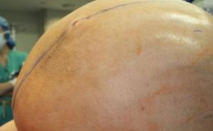 Uklonjen tumor jajnika težak skoro 60 kilograma