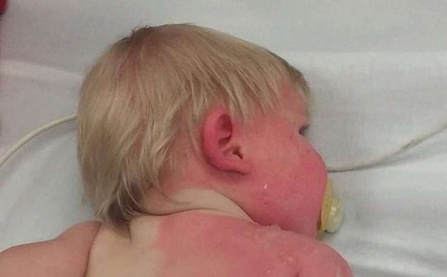 Fotografija djeteta s opeklinama po tijelu obilazi svijet i nosi važno upozorenje