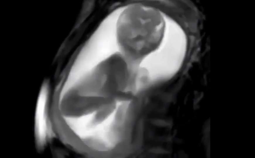 Nevjerovatni snimak kretanja bebe u majčinom stomaku 