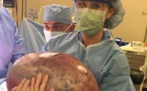 Stalno se debljala i trpjela bolove, a onda je otkrila da ima ogromnu cistu na jajniku