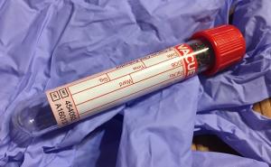 Naučnici razvili prvi krvni test za otkrivanje melanoma