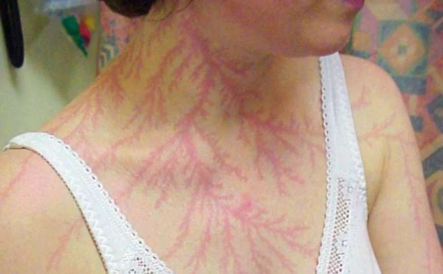 Nestvarne fotografije: Ljudi pokazali ožiljke od udara groma