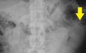 Ljekari muškarcu izvukli umjetni penis dugačak 58 cm