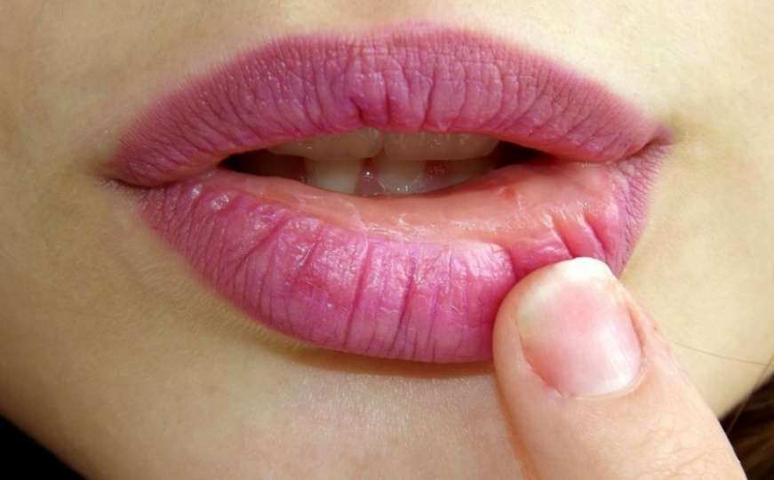 Prirodni lijek: Brzo liječenje herpesa na usnama