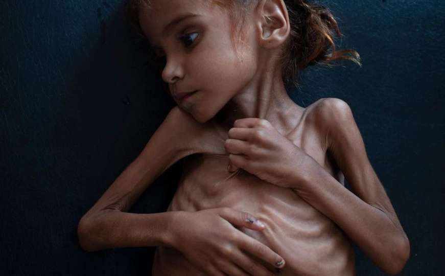 Preminula djevojčica čija je fotografija skrenula pažnju svijeta na glad u Jemenu