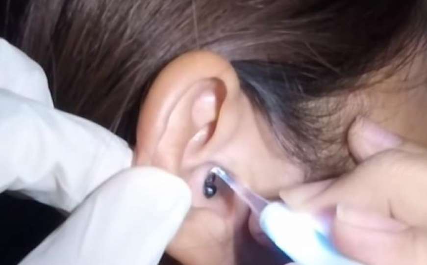 Imala nesnosni bol u ušima, nakon pregleda doktor se skamenio kada je vidio uzrok