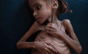 U Jemenu više od 84 hiljade djece umrlo od neuhranjenosti