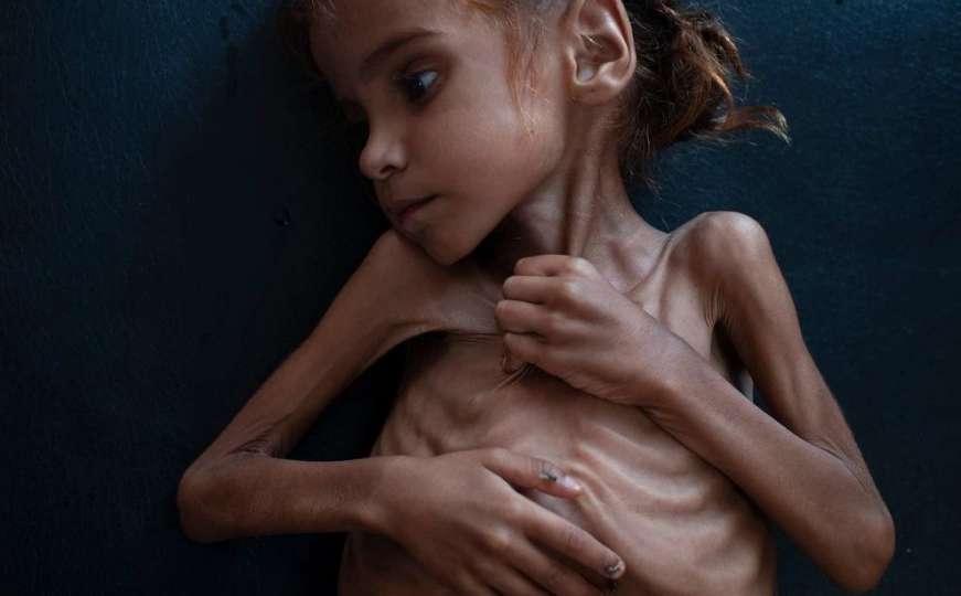 U Jemenu više od 84 hiljade djece umrlo od neuhranjenosti