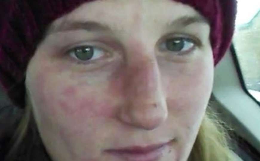 Rijetka bolest: Djevojka iz Kanade alergična na zimu