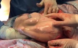 Rađanje bebe koje je zapanjilo svijet: Čekali smo je punih 7 minuta, ovo je čudo
