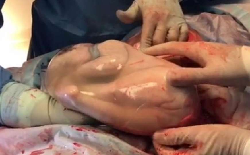 Rađanje bebe koje je zapanjilo svijet: Čekali smo je punih 7 minuta, ovo je čudo