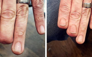 Tattoo majstor muškarcu vratio nokte na amputiranim prstima 