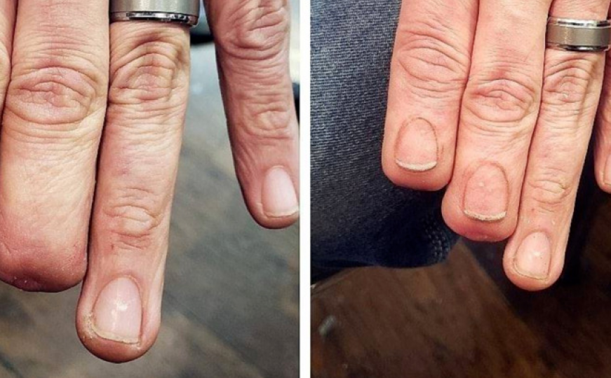 Tattoo majstor muškarcu vratio nokte na amputiranim prstima 