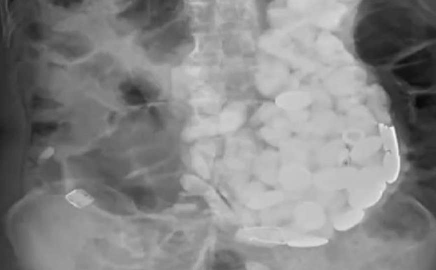 Hirurzi zapanjeni: Pacijentu iz stomaka izvadili kamenje, kovanice i čepove