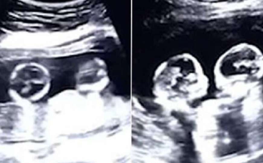 Roditelji će imati pune ruke posla: Na ultrazvuku vidjeli prvi obračun blizanki