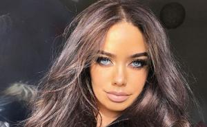 Blogerici otekle usne zbog filera: Umirala mi je gornja usna i zamalo otpala