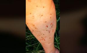 Želio je samo zaliti baštu, a komarci ga napali, ništa mu nije pomoglo