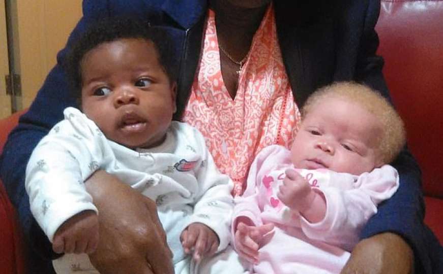 Neobični blizanci: Rodila jedno crno i jedno albino dijete