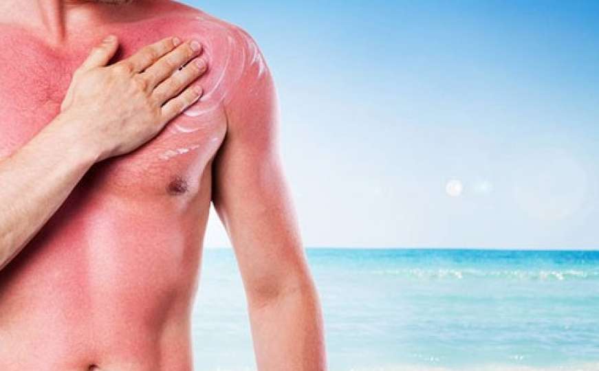 Najbrži načini da izliječite kožu ako ste izgorjeli na suncu