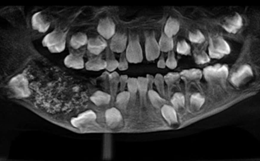 Zubar iz usta sedmogodišnjeg dječaka izvadio 526 zuba