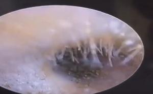 Nevjerovatan snimak: Ženi u uhu izrasle gljive koje liče na pečurke