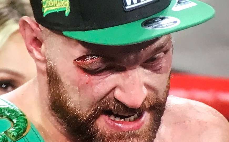 Tyson Fury slavio raskrvavljena oka: Ovo je najgori meč ikad