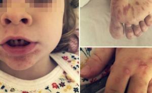 Fotografije zastrašujuće: Porodica se zarazila na odmoru u Rovinju?