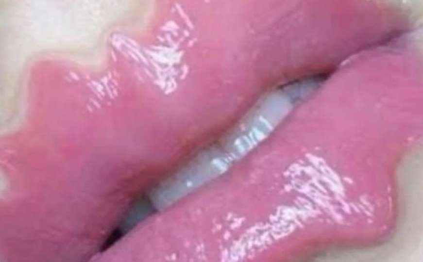 "Vražije usne": Novi bizarni trend širi se Instagramom i prigrlile su ga brojne žene