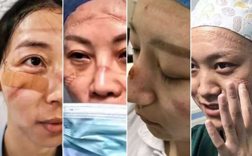Tragovi žrtvovanja na licima ljekara koji se bore s koronavirusom u Wuhanu