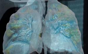 Pogledajte kakva oštećenja pluća uzrokuje COVID-19