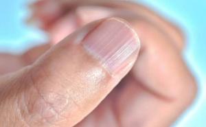 Imate vodoravne ili okomite nabore na noktima - kad treba ići doktoru?