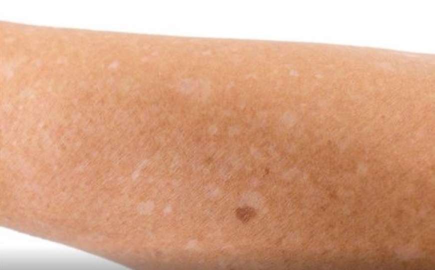 Šta znače bijele mrljice na vašoj koži?