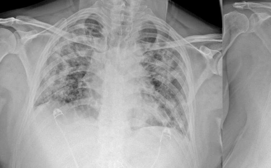Doktorica objasnila šta COVID-19 radi plućima: Pokazala i snimke