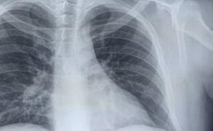 Hirurg iz Srbije objavio snimak pluća: Pacijent je umro za dva dana