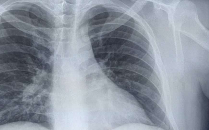 Hirurg iz Srbije objavio snimak pluća: Pacijent je umro za dva dana