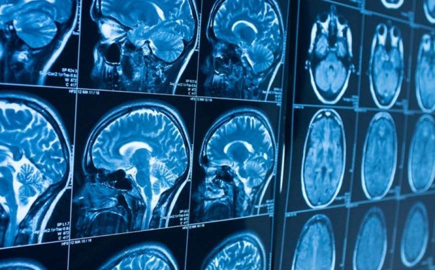 Najzagonetniji simptomi COVID-a: Šta su otkrile snimke mozga zaraženih
