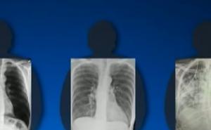 Doktorica objavila snimke pluća pušača i oboljelog od COVID-a: Jeziva razlika