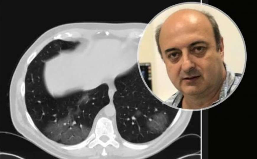 Radiolog objavio slike i upozorio: Pogledajte šta COVID napravi plućima za 4 dana