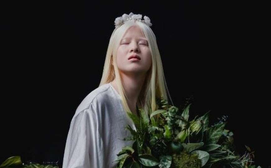 Xueli Abbing: Napuštena albino beba koja je postala model Voguea