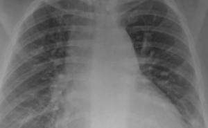 Doktor objavio snimak pluća vakcinisanih, i nevakcinisanih zaraženih pacijenata
