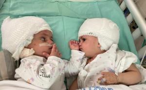 Sestrice se vidjele prvi put: Uspješno razdvojene sijamske blizanke